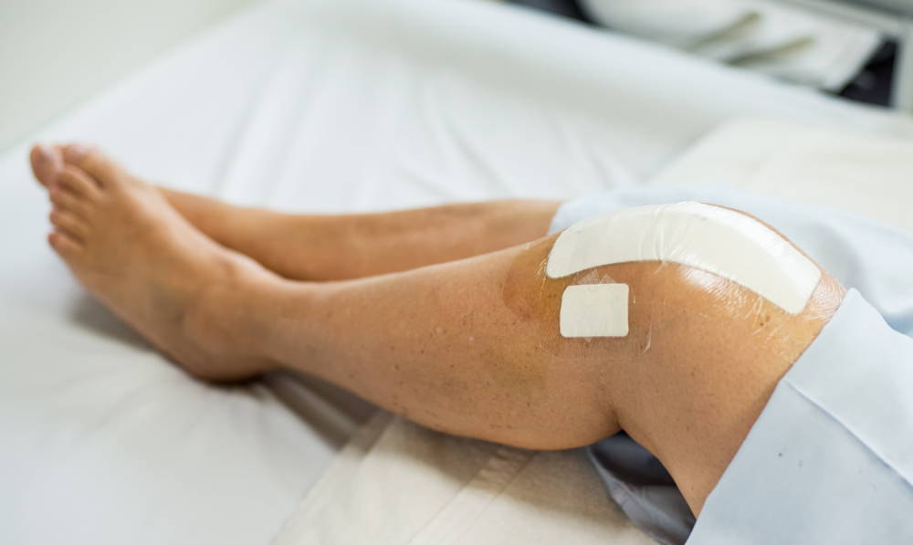 Total Knee Replacement Recovery What To Expect After Knee Replacement